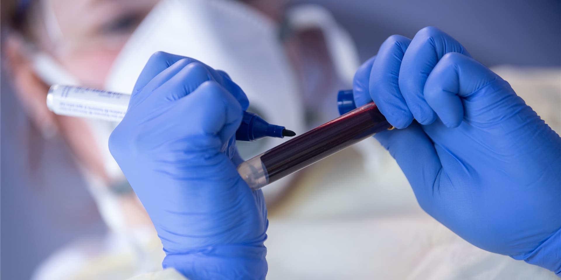 Forscher in den USA haben bei Corona-Patienten verlangsamte Hirnströme festgestellt – das könnte auf Folgeschäden hindeuten.