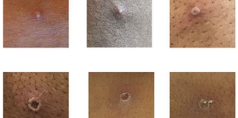 Hautläsionen bei Patienten, bei denen Affenpocken nachgewiesen wurden.