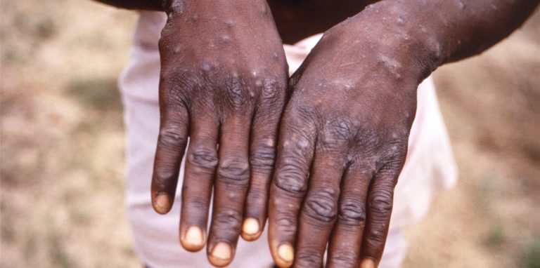 Dieses Bild aus dem Jahr 1997, das von der CDC während einer Untersuchung eines Affenpockenausbruchs in der Demokratischen Republik Kongo (DRC), dem früheren Zaire, zur Verfügung gestellt wurde, zeigt die Rückenflächen der Hände eines Affenpocken-Patienten, der den charakteristischen Ausschlag in der Erholungsphase zeigte.