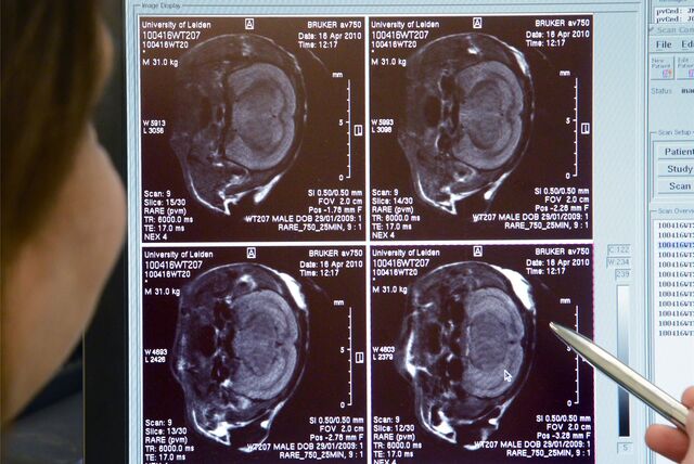 Alzheimer könnte womöglich durch medizinische Eingriffe übertragbar sein. Das Bild zeigt die Gehirne von Mäusen.