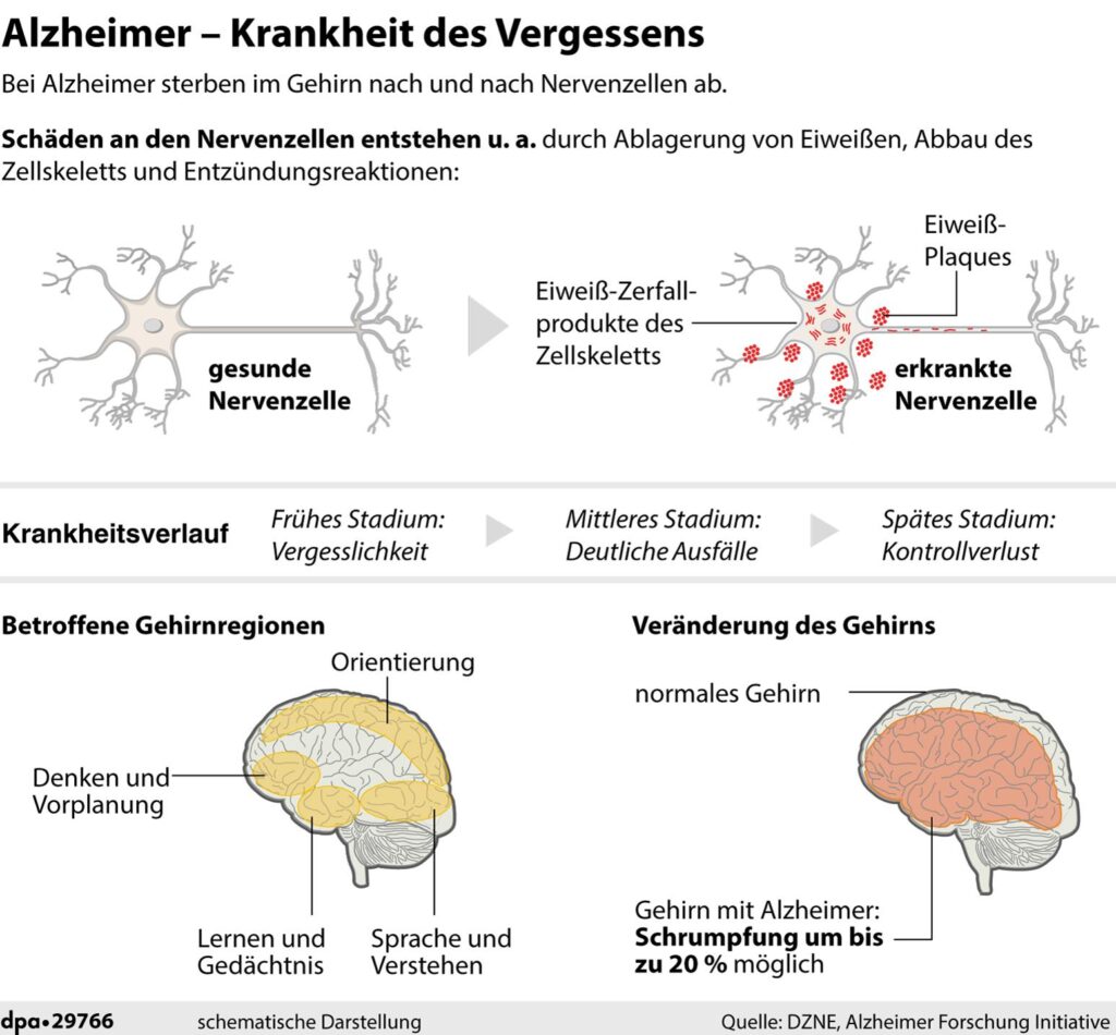 Alzheimer - Krankheit des Vergessens. Alzheimer - Krankheit des Vergessens.