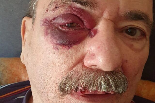 Das Gesicht von Peter Bonsendorf zeigt das Ausmaß seiner Verletzungen im Gesicht. Das rechte Auge ist blutunterlaufen und geschwollen.