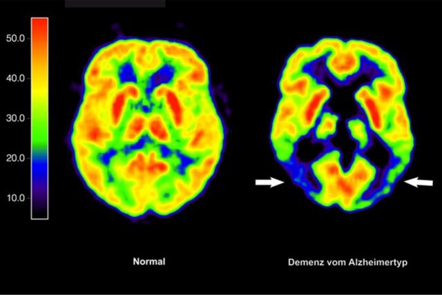 Die mit der Positronen-Emissions- Tomografie (PET) erstellte Abbildung zeigt die Gegenüberstellung zweier Gehirne – im gesunden Zustand (l) und mit Alzheimer-Krankheit (Handout von 2012).