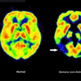 Die mit der Positronen-Emissions- Tomografie (PET) erstellte Abbildung zeigt die Gegenüberstellung zweier Gehirne – im gesunden Zustand (l) und mit Alzheimer-Krankheit (Handout von 2012).