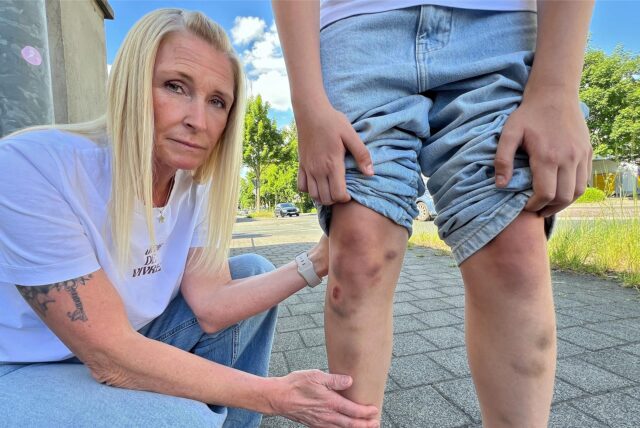 Blaue Flecken und Schürfwunden sind die Folgen eines Unfalls am Zebrastreifen an der Iserlohner Straße in Unna, hier die Mutter des verunglückten Teenagers.